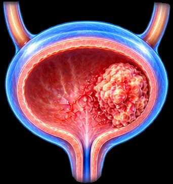 Bladder Cancer