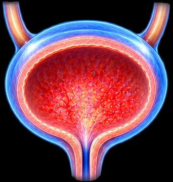 Cystitis