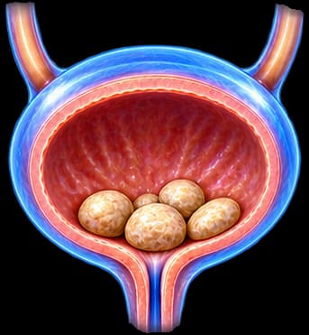 Bladder Stones