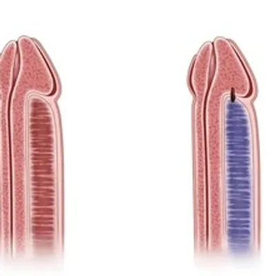 Priapism