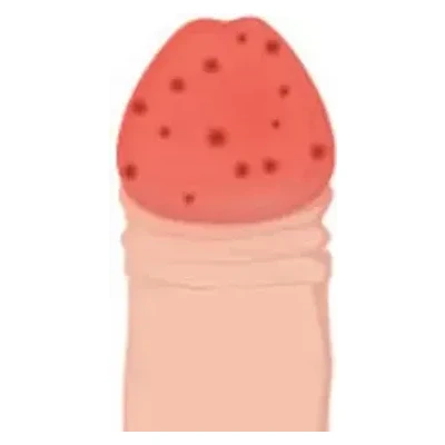 Balanitis
