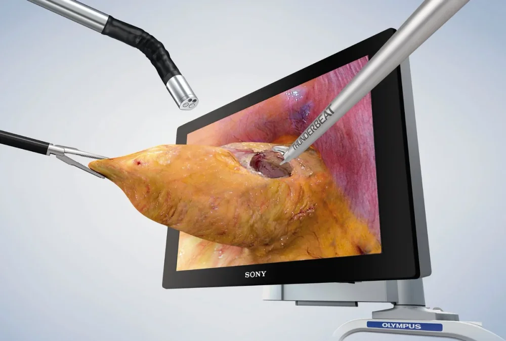 3D λαπαροσκοπικά εργαλεία και οθόνη υψηλής ευκρίνειας κατά τη διάρκεια λαπαροσκοπικής ουρολογικής επέμβασης